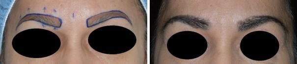 Hair Transplant before and after, marked.