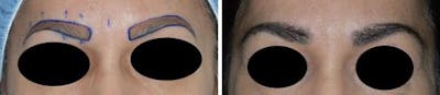 Hair Transplant before and after, marked.