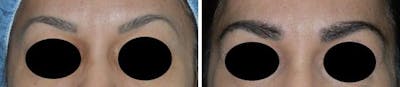 Hair Transplant before and after, frontal.