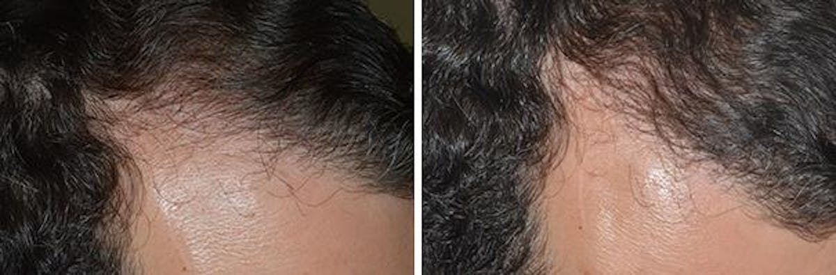 Hair Transplant before and after, oblique right.