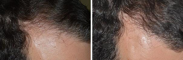 Hair Transplant before and after, oblique right.