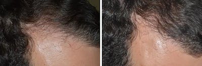 Hair Transplant before and after, oblique right.