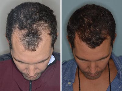 Hair Transplant before and after, frontal.