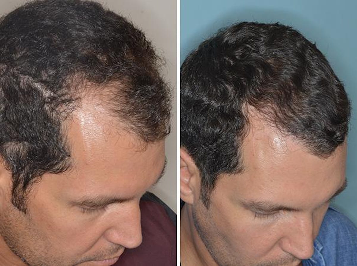 Hair Transplant before and after, oblique right.