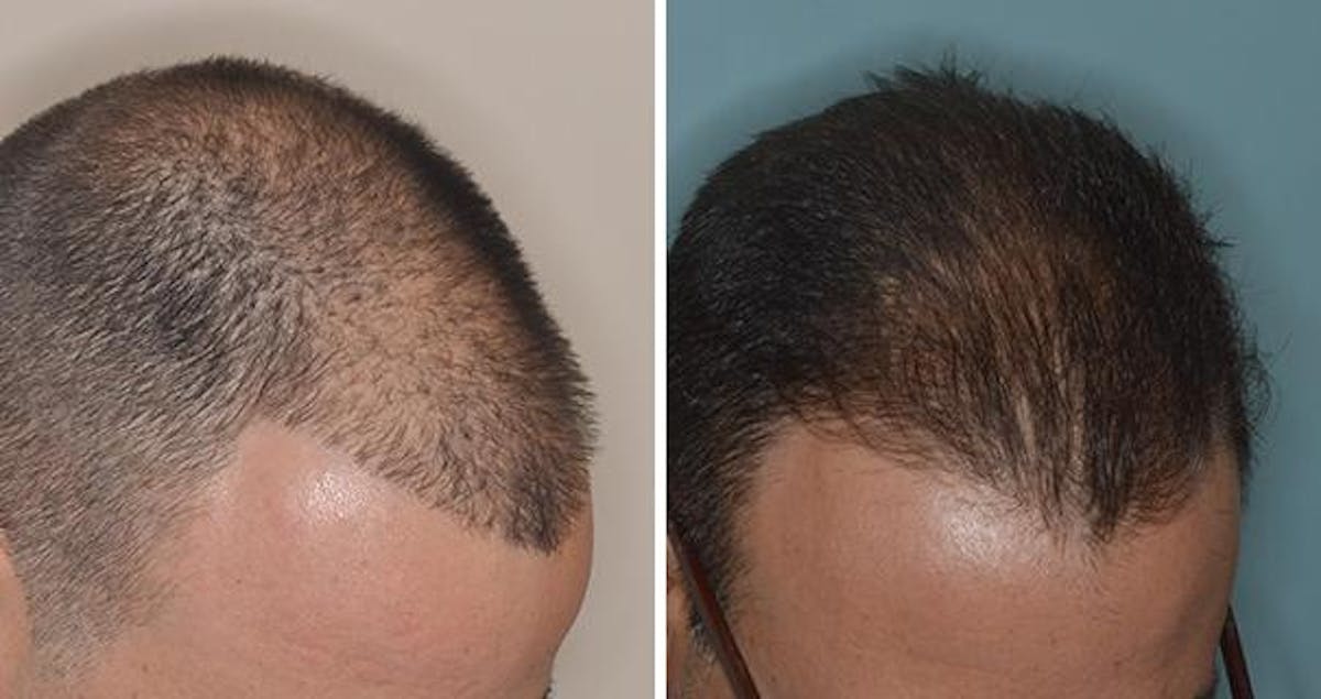 Hair Transplant before and after, oblique right.