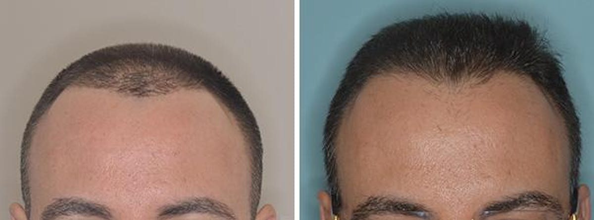 Hair Transplant before and after, frontal.