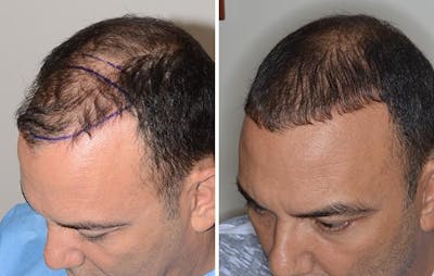 Hair Transplant before and after, oblique left.