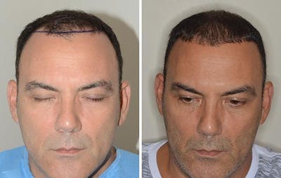 Hair Transplant before and after, frontal.