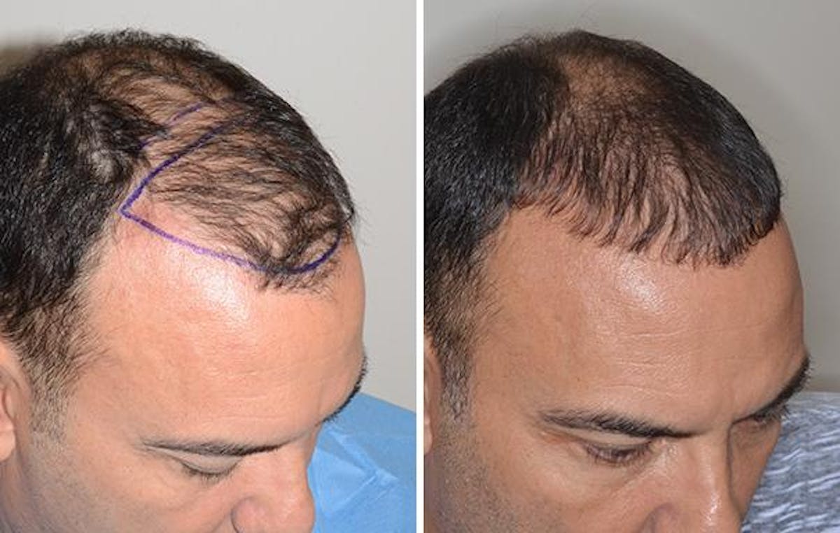 Hair Transplant before and after, oblique right.