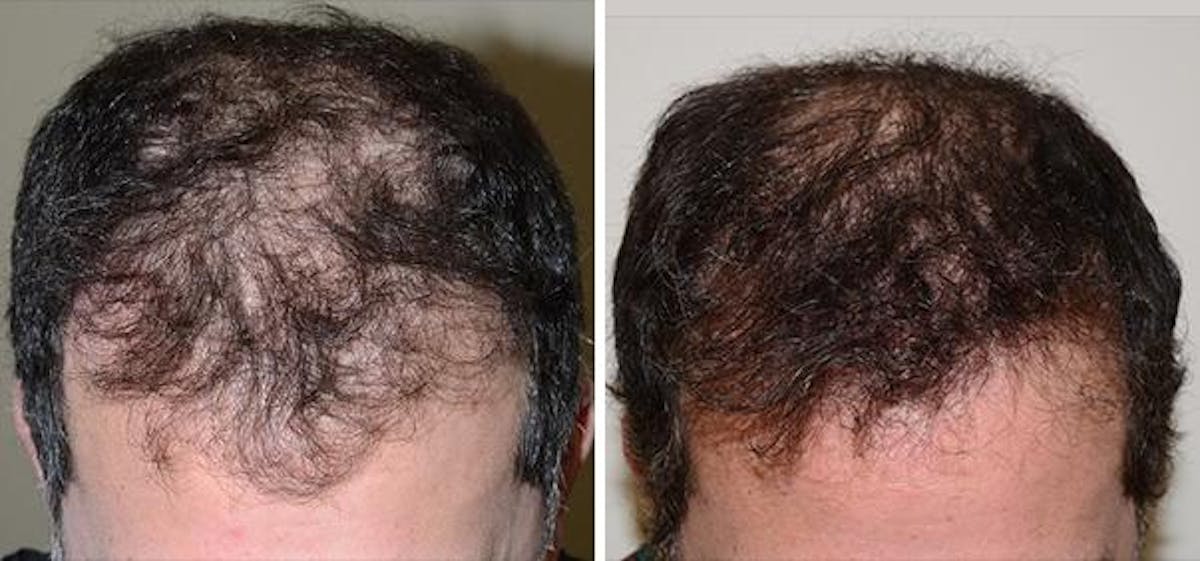 Hair Transplant before and after, frontal.