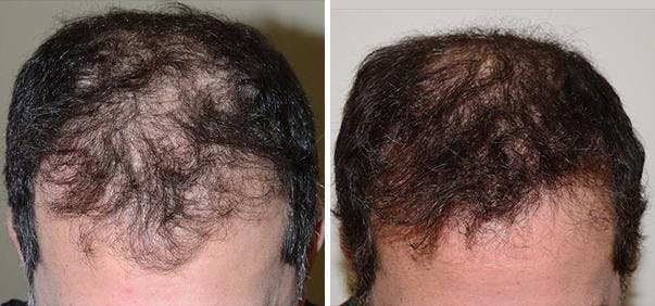 Hair Transplant before and after, frontal.