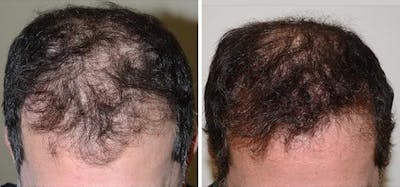 Hair Transplant before and after, frontal.