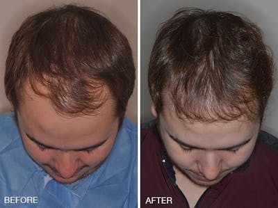 Hair Transplant before and after, frontal.
