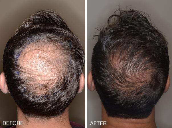 Hair Transplant before and after, frontal.