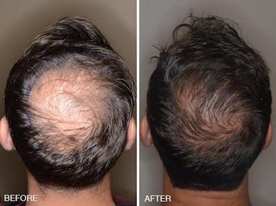 Hair Transplant before and after, frontal.