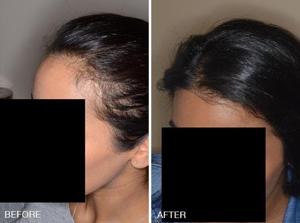Hair Transplant before and after, oblique left.