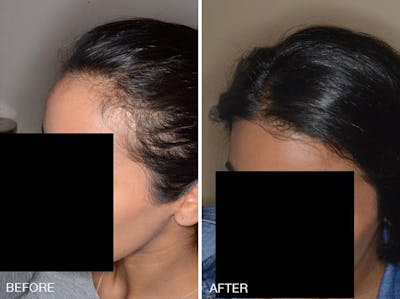 Hair Transplant before and after, oblique left.