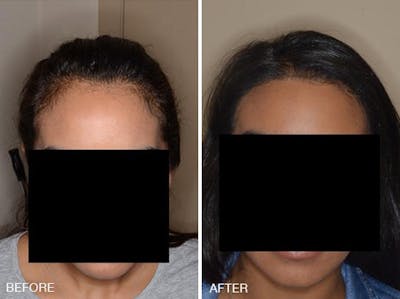 Hair Transplant before and after, frontal.