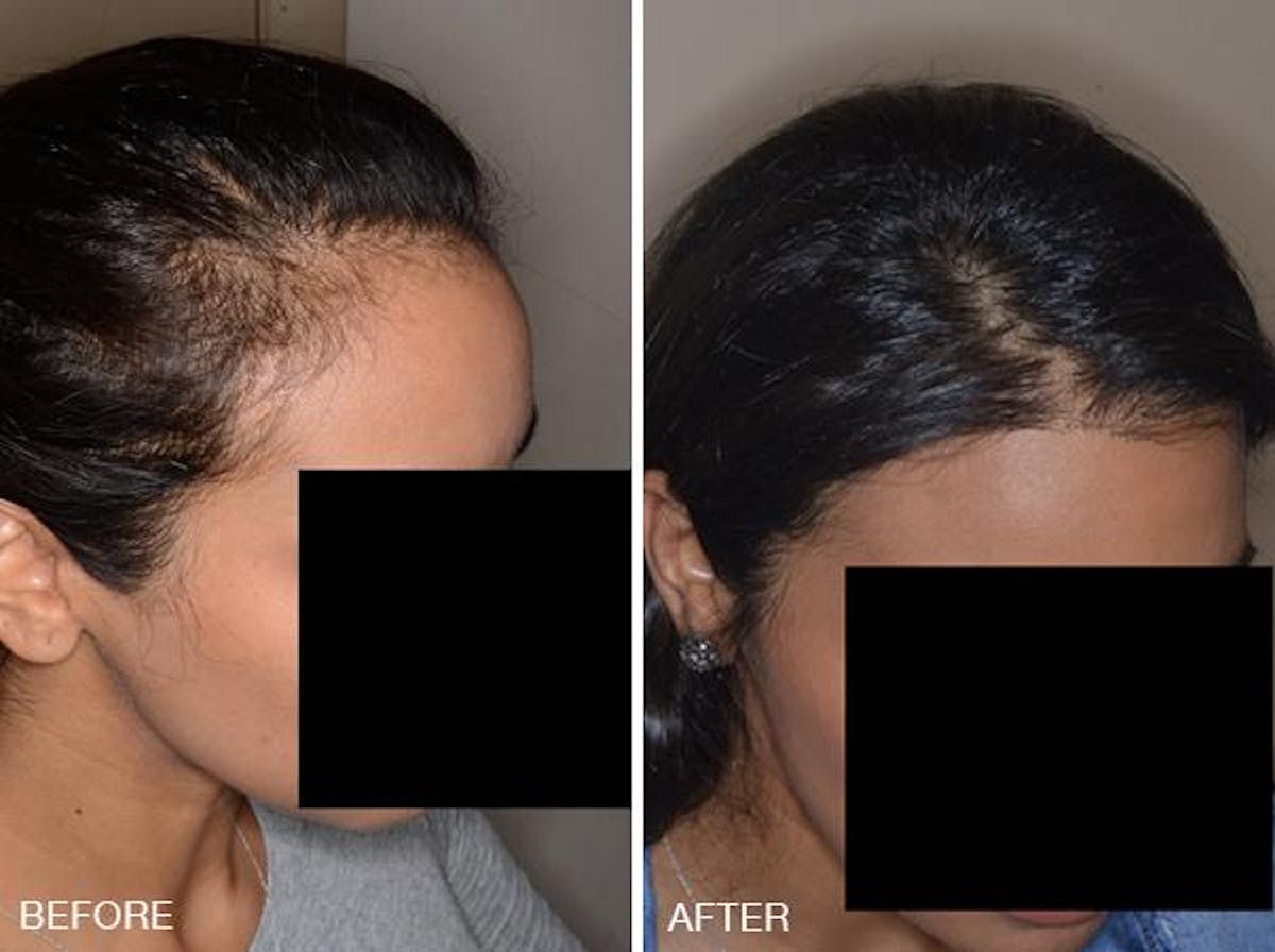 Hair Transplant before and after, oblique right.