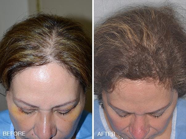 Hair Transplant before and after, frontal.