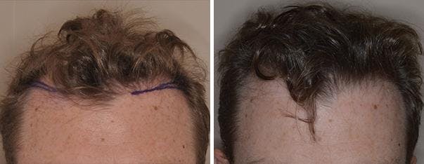 Hair Transplant before and after, frontal.