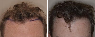 Hair Transplant before and after, frontal.