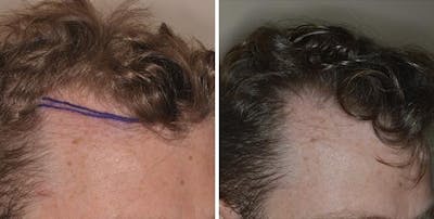 Hair Transplant before and after, oblique right.