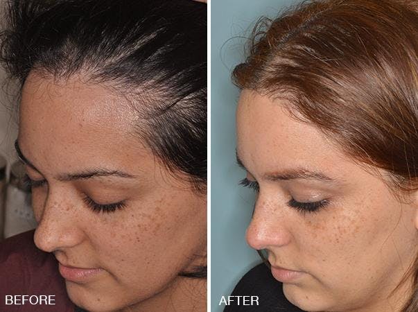 Hair Transplant before and after, oblique left.