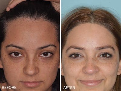 Hair Transplant before and after, frontal.