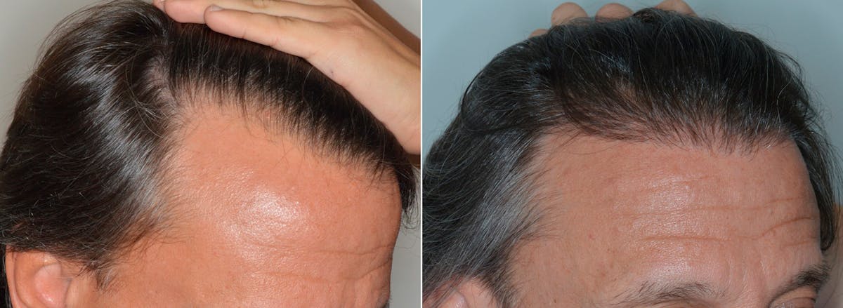 Hair Transplant before and after, oblique right.