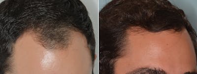 Hair Transplant before and after, oblique right.