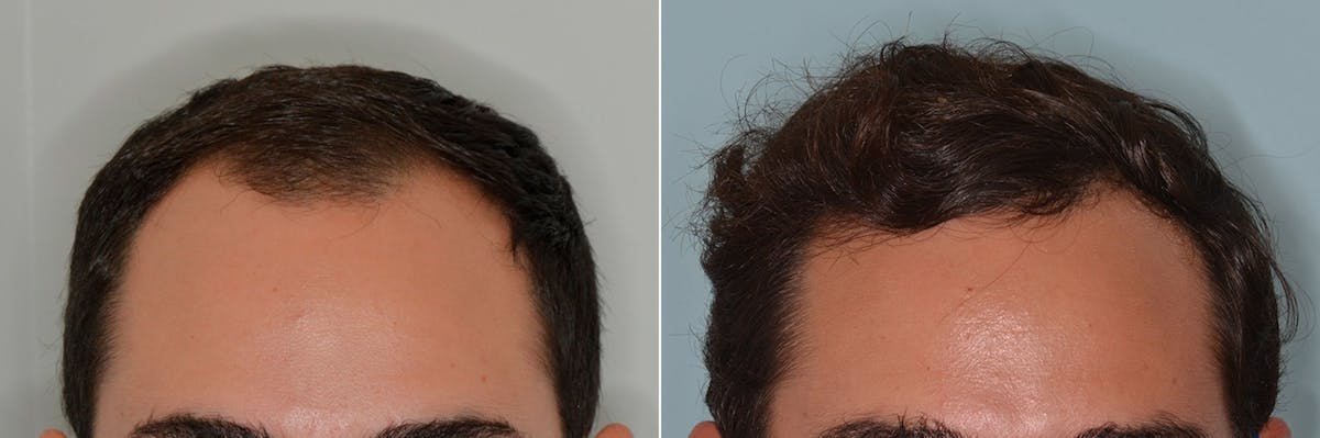 Hair Transplant before and after, frontal.
