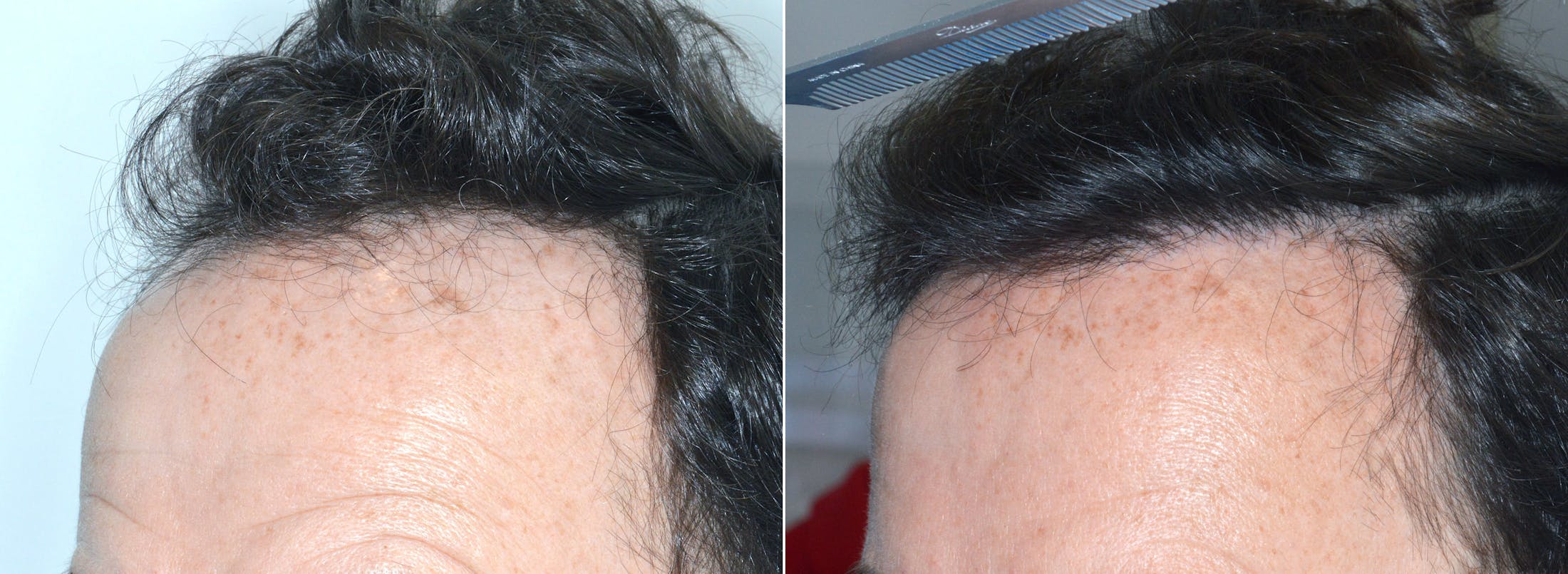 Hair Transplant before and after, oblique left.