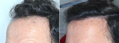 Hair Transplant before and after, oblique left.