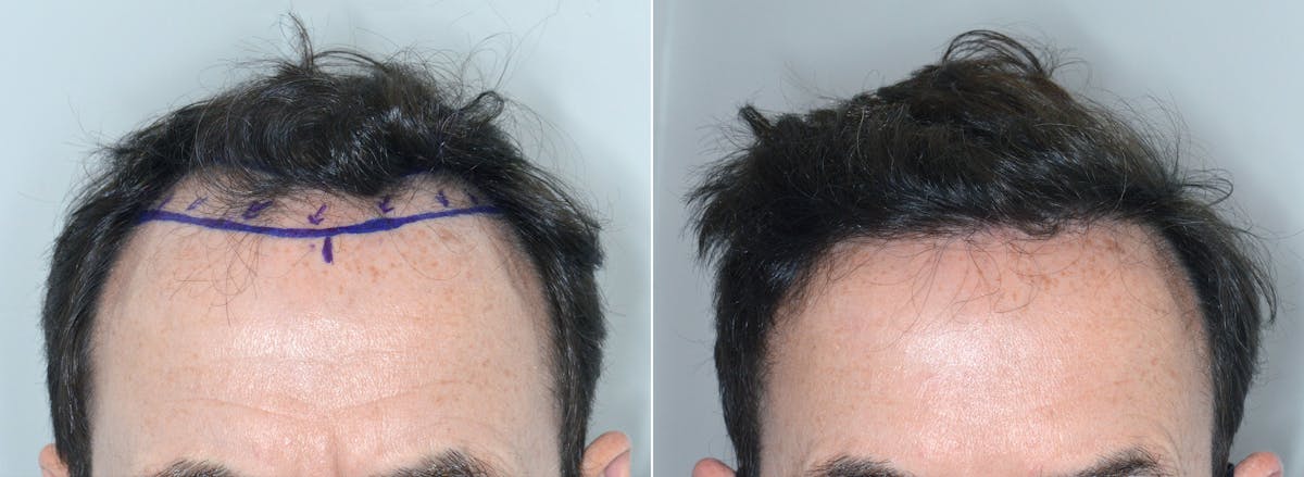 Hair Transplant before and after, frontal.
