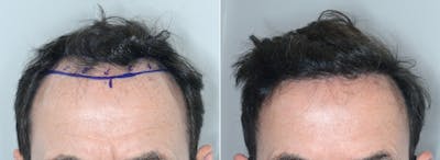 Hair Transplant before and after, frontal.