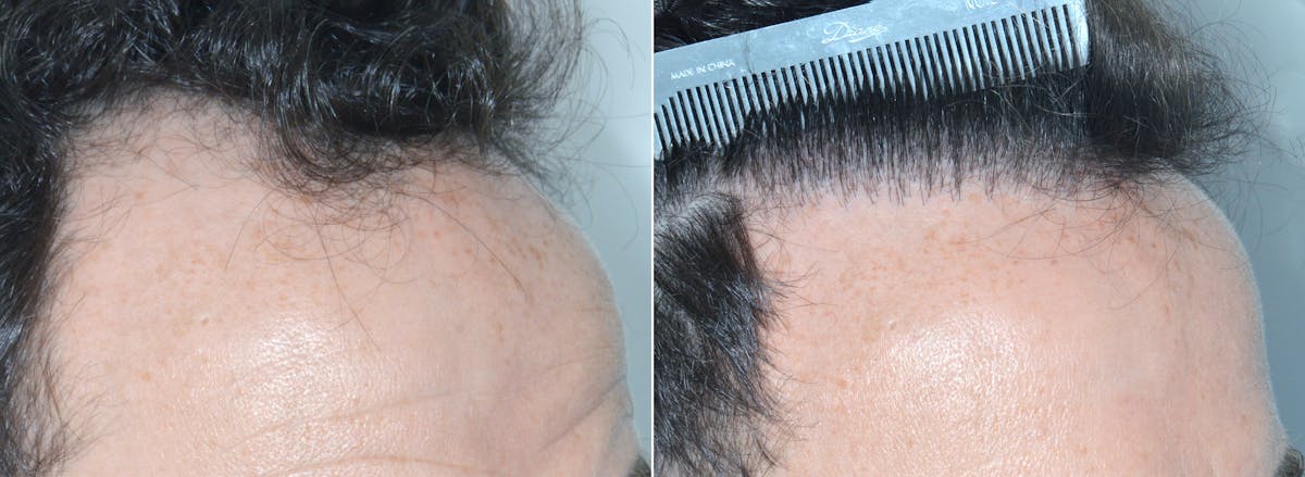 Hair Transplant before and after, oblique right.