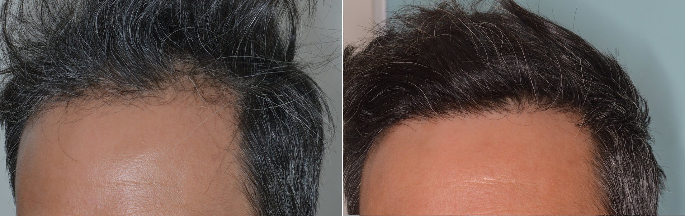 Hair Transplant before and after, oblique left.