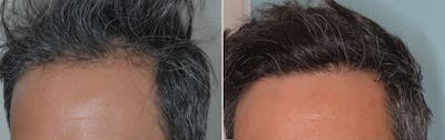 Hair Transplant before and after, oblique left.