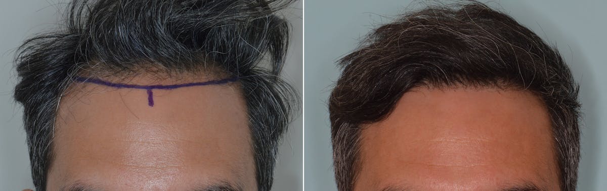 Hair Transplant before and after, frontal.