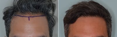 Hair Transplant before and after, frontal.