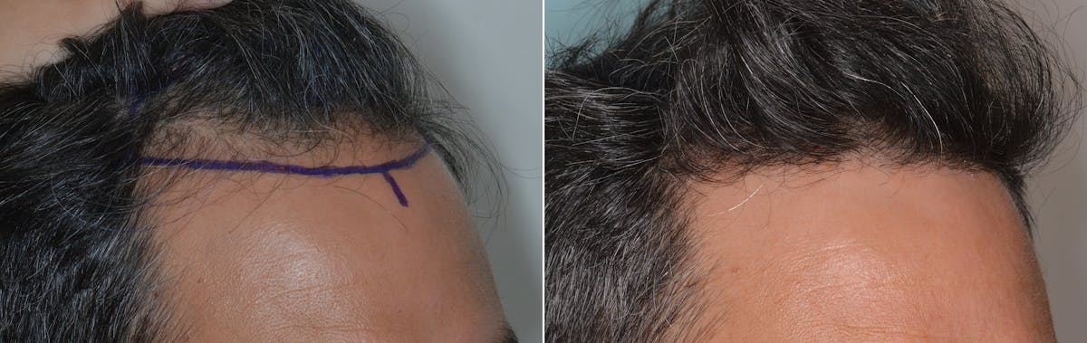 Hair Transplant before and after, oblique right.