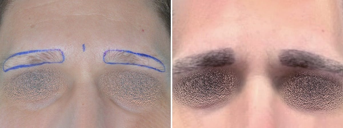 Hair Restoration before and after, frontal.