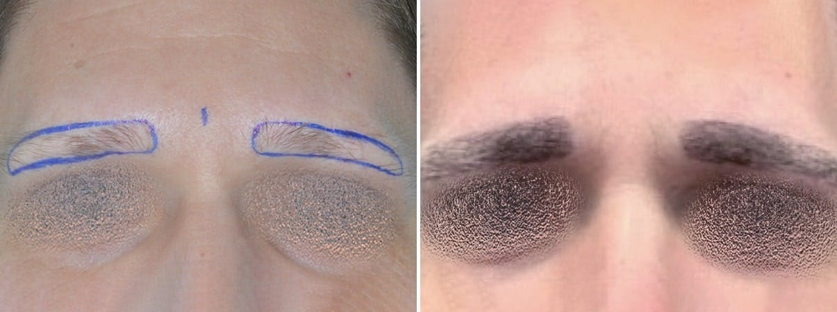 Hair Restoration before and after, frontal.