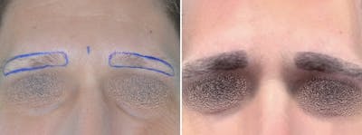 Hair Restoration before and after, frontal.