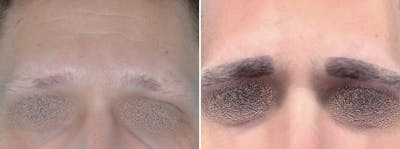 Hair Restoration before and after, frontal.