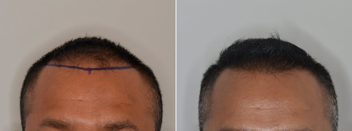 Hair Restoration before and after, frontal.