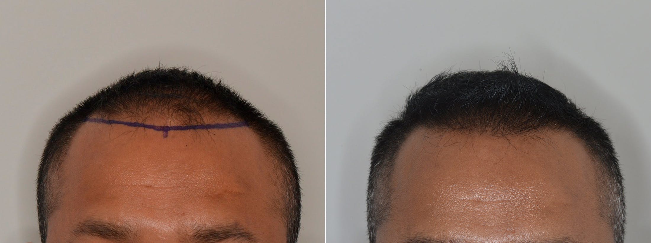 Hair Restoration before and after, frontal.