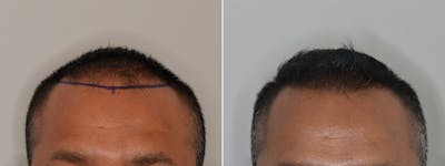 Hair Restoration before and after, frontal.