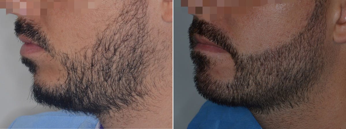 Hair Restoration before and after, lateral left.
